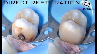 Direct Restoration Composite