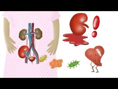 How does a Kidney Transplant work?