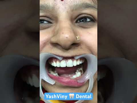 Composite se smile banana dental clinic #smile #dentist #smiledental #dentalcare #jodhpur