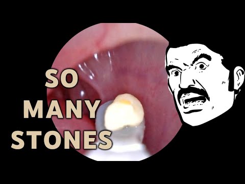 Removing Tonsil Stones | AIM 22