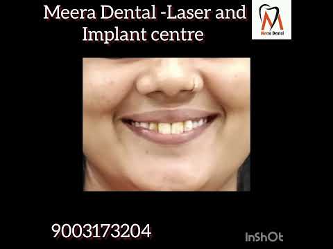 Get rid of yellow teeth