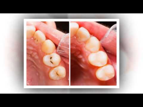 Fillings | Redding, CA – Moore & Pascarella Dental Group
