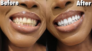 😮 How To: Teeth Whitening At Home NO Hydrogen Peroxide