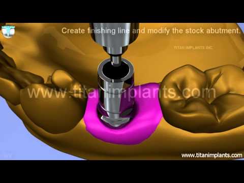 How to take Open tray impression and use Lifecore Compatible stock abutment to make crown and bridge