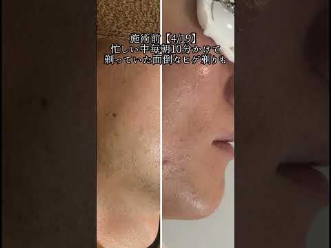 【劇的ヒゲ脱毛ビフォーアフター】毎朝10分かかるヒゲ剃りがめんどうでどうにかしたいと悩んでいた30代のお客様がヒゲ脱毛15回やってみた結果 #shorts