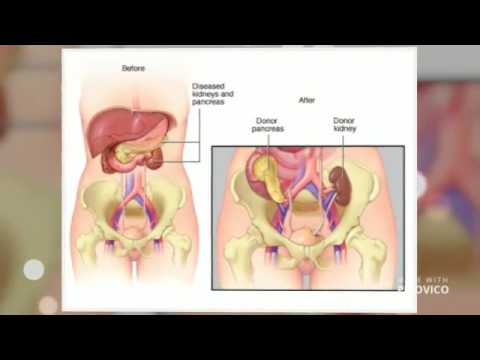 Pancreas Transplant In Delhi