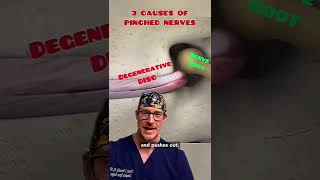 3 Causes of Pinched Nerves (explained by a spine surgeon) 🤓