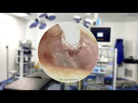 Earwax cleaning both Right and left ear of an old man that never cleans for 20 years