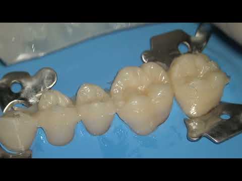 Direct Restoration of Worn Teeth - Occlusal Silicone Index
