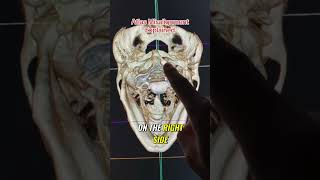 Unlocking the Secrets of Atlas Misalignment: Neurologic Conditions Explained