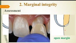 Try-in: 2- Marginal integrity