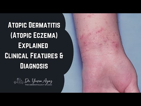 Lecture 1: Atopic Dermatitis (Atopic Eczema) Explained: Clinical Features & Diagnosis