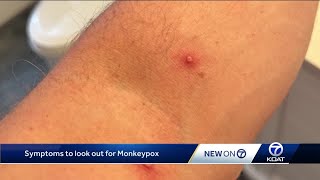 What are the monkeypox symptoms?