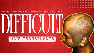 Hair Transplant in India | Side-effects &Risk of Hair Transplant #sideeffectsofhairtransplant