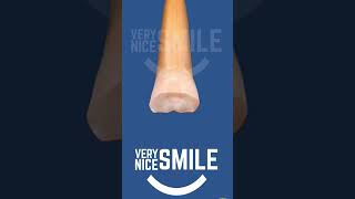 Front tooth root canal