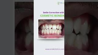 Transform Your Smile with Cosmetic Bonding | Smile Correction at Oro Dental Clinic #orodentalclinic