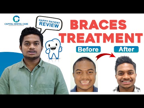 Braces Treatment Safe And Fast Growing Results || Patient Happy Review || Capital Dental Care