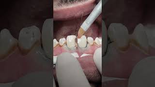 Anterior teeth proximal caries composite restoration #dentist