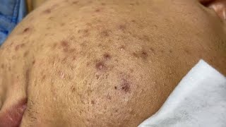 ASMR deep cleansing asmr | acne & blackhead removal#asmr 