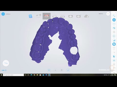 Implant - Scanning an Implant