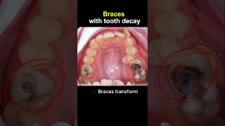 Braces for tooth decay #orthodontist #dentist #dentist #braces