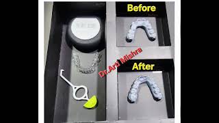 Before & After Dental Aligners | Digital Scan Result at Save Tooth Dental Clinic