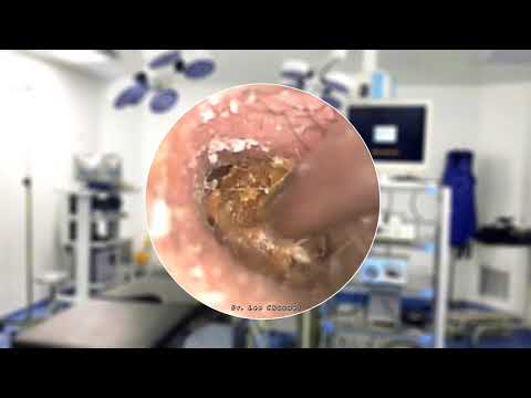 Remove stuck EARWAX from a young boy’s ear