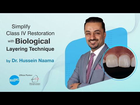 Simplify Class IV Restoration with Biological Layering Technique by Dr. Hussien Naama