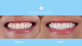 Injected resin veneers