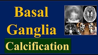 Basal Ganglia Calcification