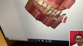 Digital Impression for Dental Implant Crown