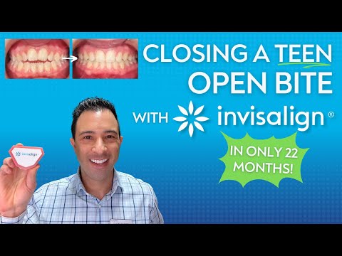 Closing a Teen's Open Bite With INVISALIGN!