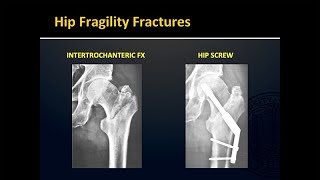 Fragility Fractures