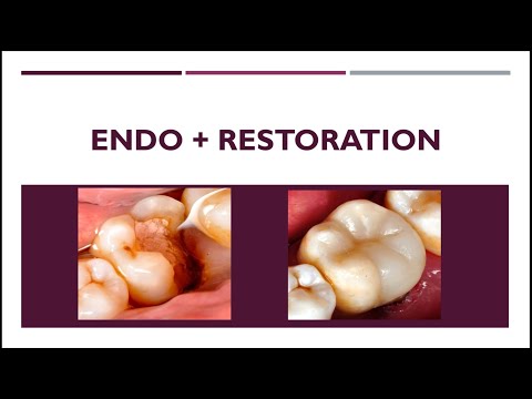#teethrestoration Endo + restoration