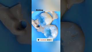 🤯👌👌Teeth Care | Case 29 | fill your caries tooth | Your Dentist #shorts #shortvideo #short