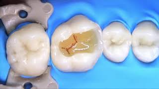 STEP BY STEP DIRECT RESTORATION CLASS II | ABOUT DENTISTRY