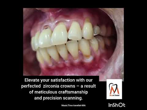 Reviving smiles:Zirconia crowns #dentist #beautiful #smile