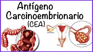 Carcinoembryonic Antigen (CEA)