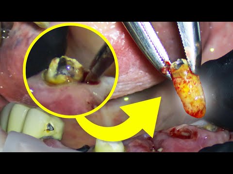 Before You Pull That Tooth, Watch This! Shocking tooth extraction