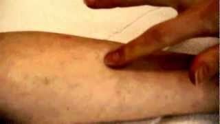 How to take a TB Skin Test