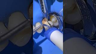 When patients ask if a crown can be biomimetic...✨ #shorts #dentalcrowns #dentist
