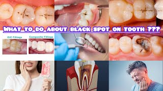What to do about the black spot on Tooth🦷#dentalcare #savetooth#savesmile #youtubevideo