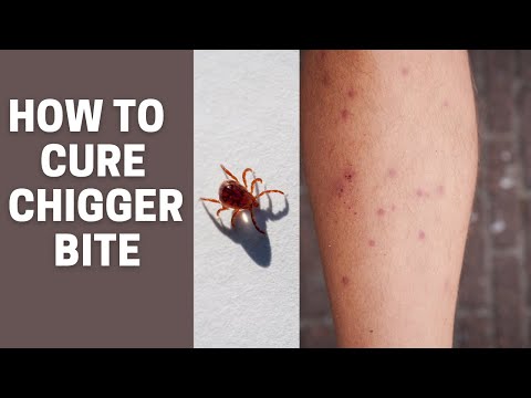 chigger bite treatment at home | how to treat chigger bites