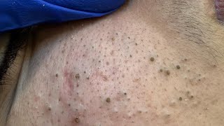 Deep Cleansing Techniques for Clear Skin | Acne, Blackheads, and Whiteheads