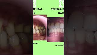 Smile designing with Metal ceramic crown #affordablecrown #dentistinchennai  #dentist #dentistnearme