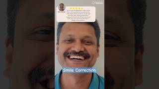 Smile correction using composites.✨#smilemakeover #smilecorrection