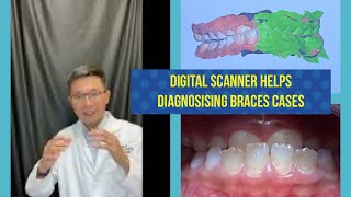 How Digital Impression Can Help Your Young Patient Malocclusion