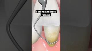 Scaling and root planing (3D Animation)