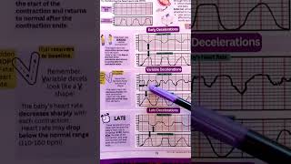Fetal Heart Tones: Early Decelerations, Variable Decelerations, and Late Decelerations #shorts