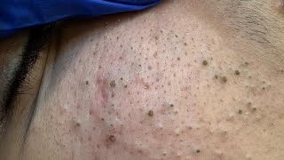 Deep Facial Cleansing for Acne | Blackheads and Whitehead Removal